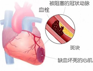 血栓的形成原因及后果，如何預(yù)防血栓導(dǎo)致的疾病
