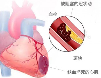 心臟病該怎么辦，且看臨床治療醫(yī)案一則